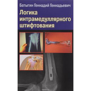 Логика интрамедуллярного штифтования